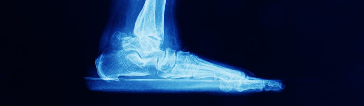 Ankle Arthritis | FASO