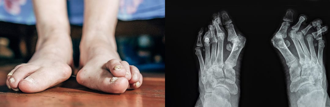 Understanding Bunion Surgery: Your Path to Pain-Free Feet