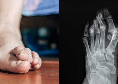 Understanding Bunion Surgery: Your Path to Pain-Free Feet