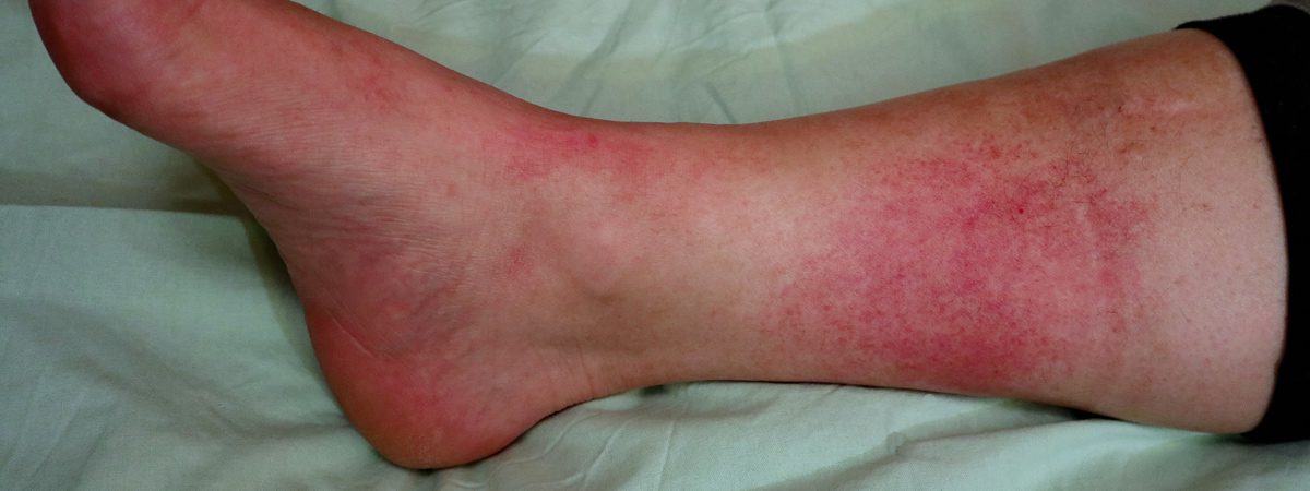 Lower Extremity Infection | FASO