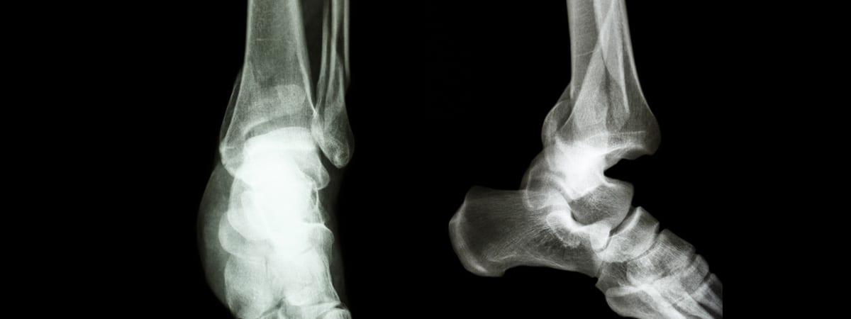 Ankle Fractures | FASO